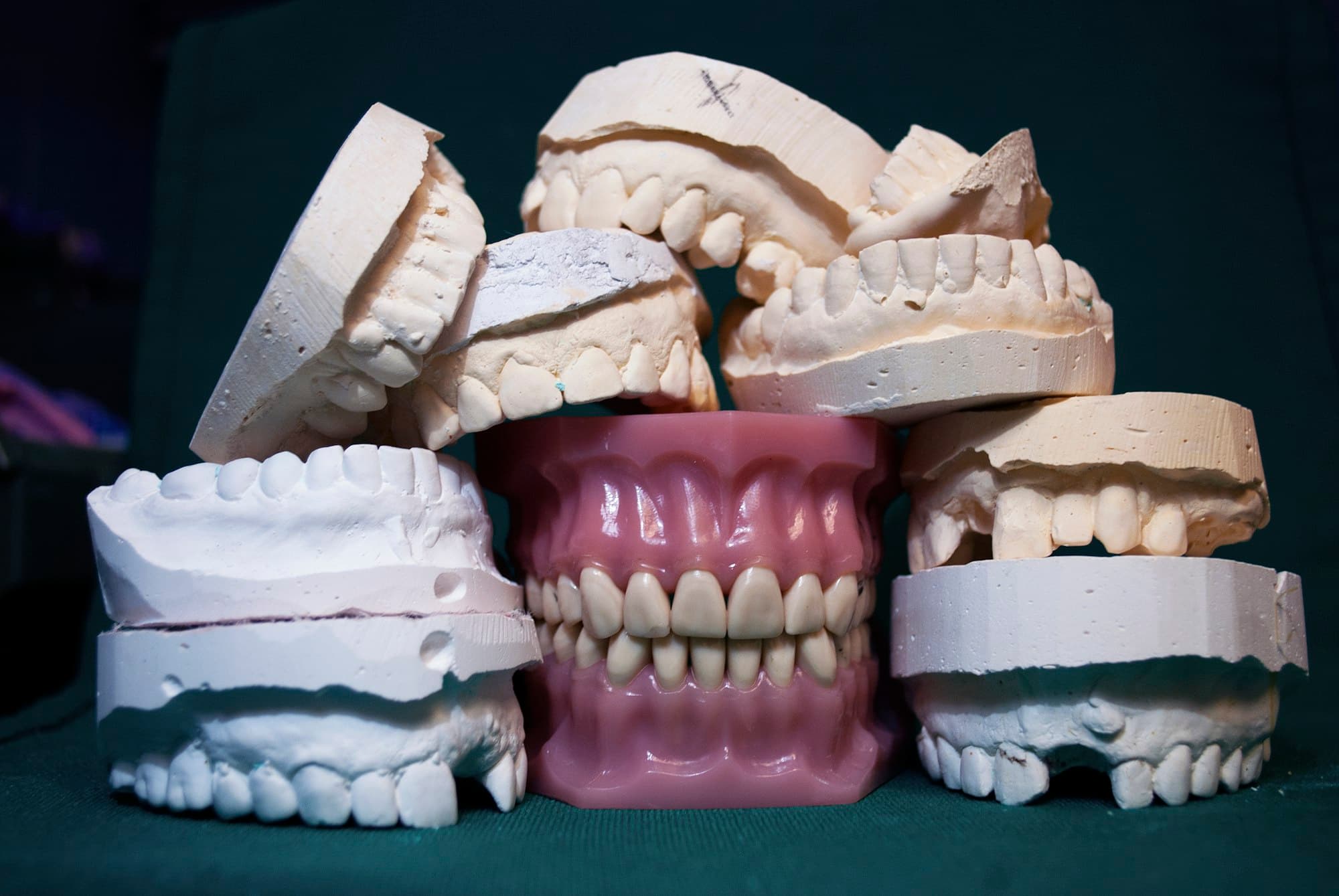 A collection of dental plaster casts